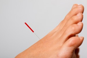 Acupuncture