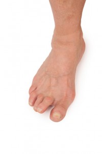 Arthritis